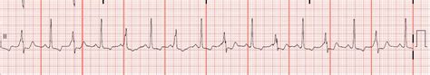 Float Nurse: Identify the appropriate electrical intervention for the ...