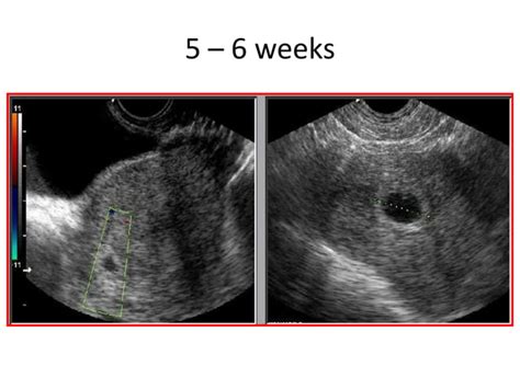 First trimester ultrasound