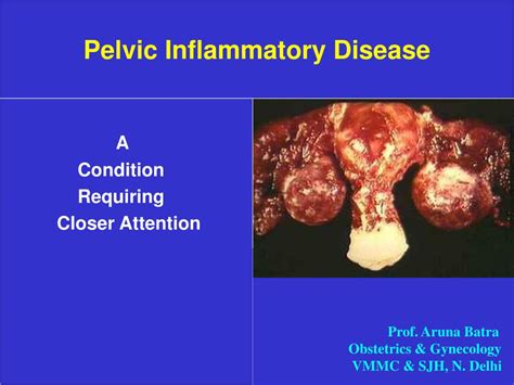 PPT - Pelvic Inflammatory Disease PowerPoint Presentation, free ...