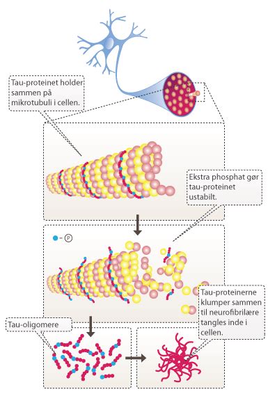 Tau Tangles - Alzheimer's disease