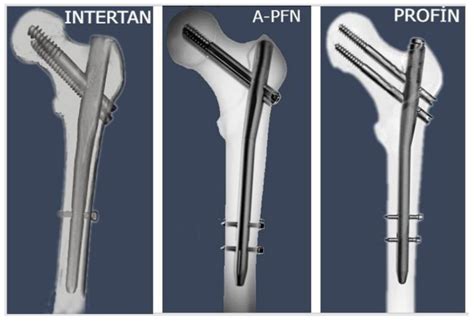 Medicina | Free Full-Text | Intertrochanteric Femoral Fractures: A ...