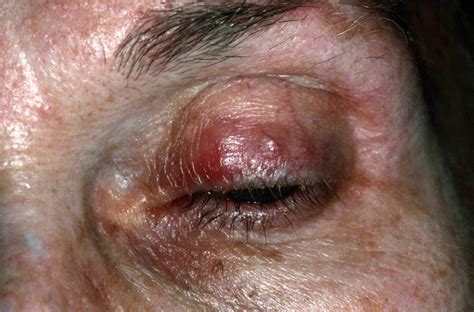 Rosacea - Causes, Symptoms, Cream, Diet & Rosacea Treatment