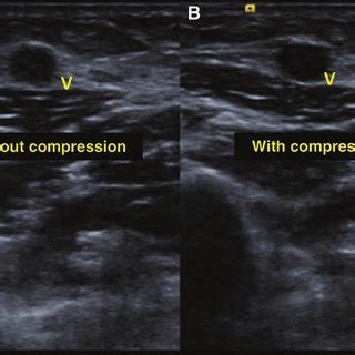 (PDF) Acute Superficial Vein Thrombosis of the Upper Extremity: A Case Report