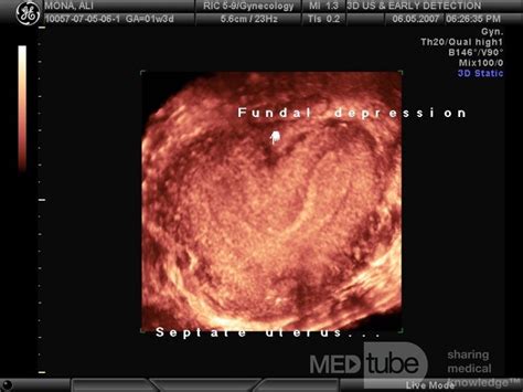 Bicornuate Uterus by 3D Ultrasound • Picture • MEDtube.net