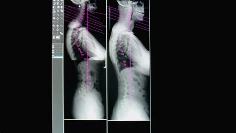 Malalignment Syndrome - SI-Instability.com