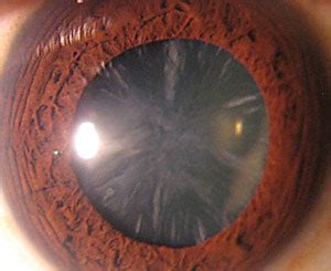 No Kidding Around: Managing Pediatric and Early-onset Cataract