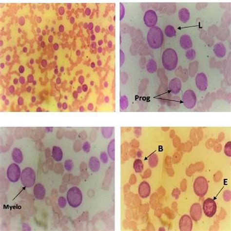 Chronic myelogenous leukemia cells in the treatment-resistant group... | Download Scientific Diagram