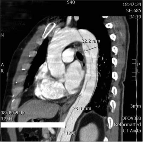 Original CT aortogram showing type-B dissection. There is only minimal ...