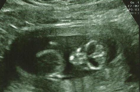 Creepy Ultrasound: 23 Images That Will Give You Nightmares | HuffPost ...