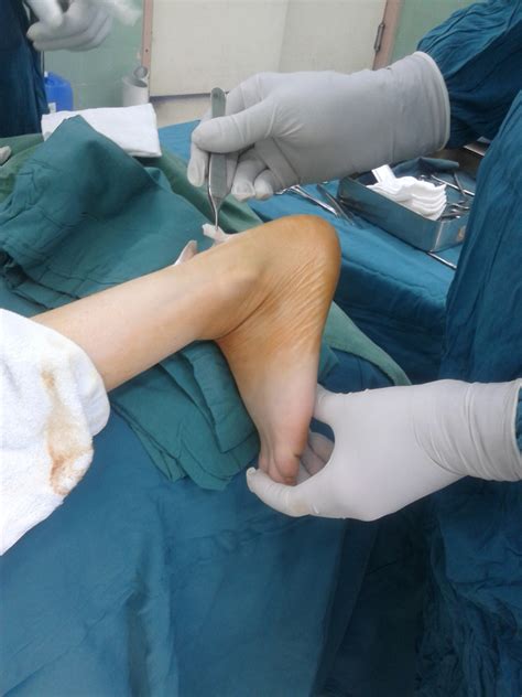 Heel spurs surgery | General center | SteadyHealth.com