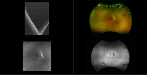 Operculated Retinal Hole In Retinal Detachment Retina