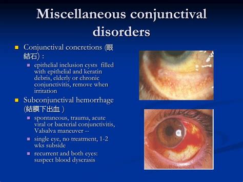 PPT - The Disease of Conjunctiva ( 結膜 ) /Sclera ( 鞏膜 ) PowerPoint Presentation - ID:3679518