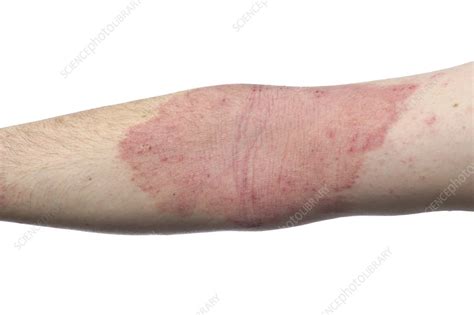 Eczema on the arms - Stock Image - C010/6664 - Science Photo Library