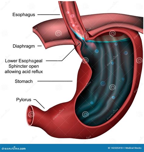 Illustrazione Medica Esofagea Di Riflusso 3d Di Anatomia Dello Sfintere Illustrazione Vettoriale ...