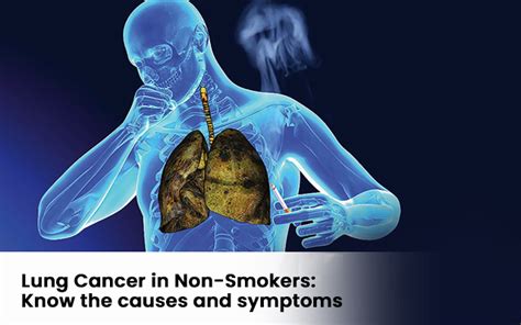 Lung Cancer in Non-Smokers: Know the Causes and Symptoms