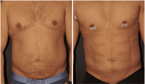 The Wow Effect: Precision Fat Elimination with Vaser Lipo: Michael Schwartz, MD: Cosmetic Surgeon