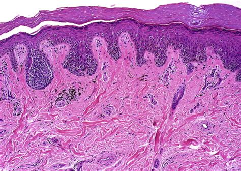 Acral Lentiginous Melanoma - Surgical Pathology Clinics