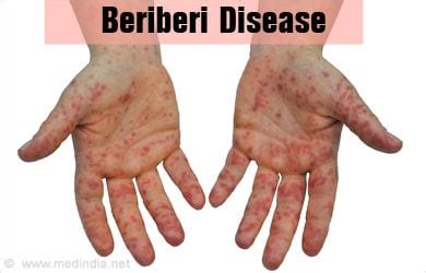 Beriberi Disease - Print