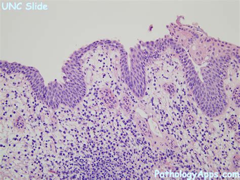 Caruncle Urinary Tract Histology 26496 | The Best Porn Website