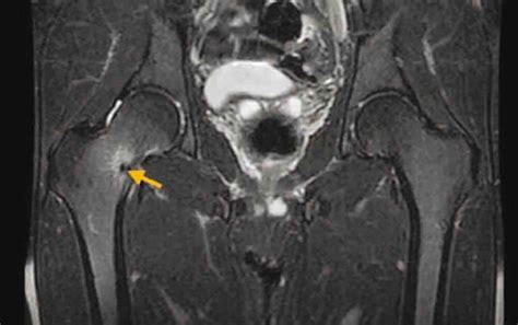 Femoral Neck Stress Fracture and Femoroacetabular Impingement | Journal ...