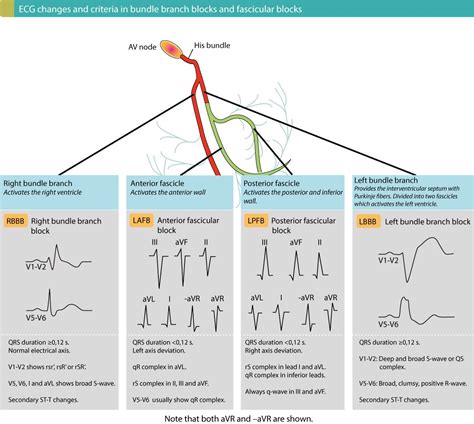 Overview of intraventricular conduction delay / defect – ECG learning