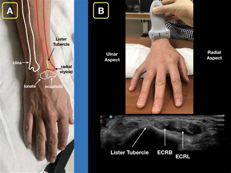 Easy Ultrasound Technique to Evaluate and Aspirate an Atraumatic ...