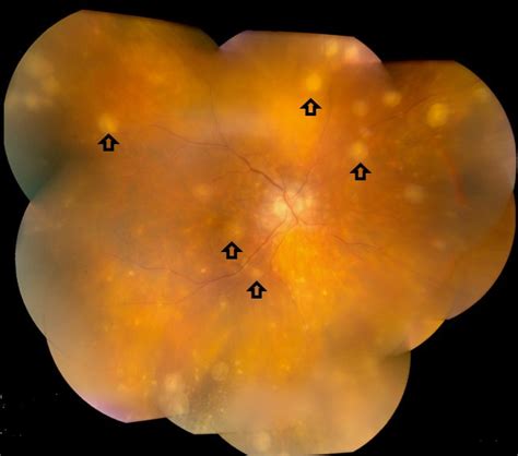 Sympathetic ophthalmia: to the twenty-first century and beyond ...