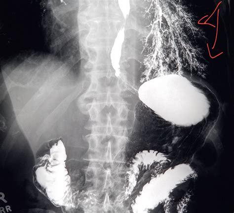 #Xray from #barium study shows #aspirated #contrast in the #lung. #radiology #radiologist # ...