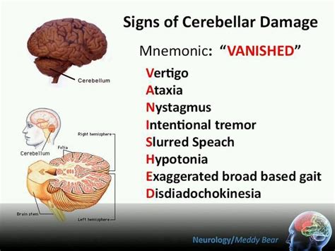 There are several mnemonics on memorizing signs of Cerebellar Damage ...