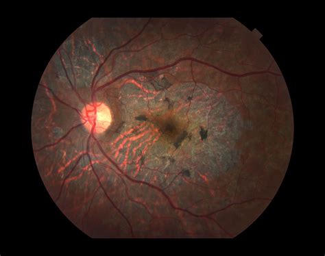 Macular Dystrophy, Ophthalmic Medicine Photograph by Paul Whitten