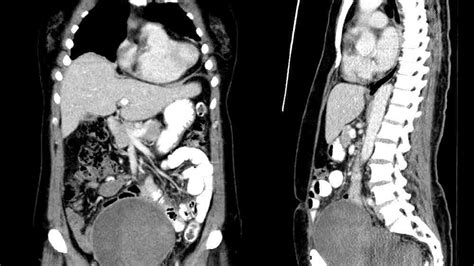 Computed tomography of the abdomen and pelvis