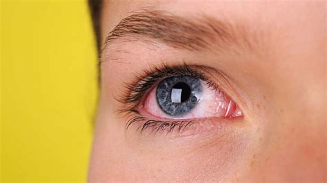 Eye Floaters: 10 Causes of Eye Floaters