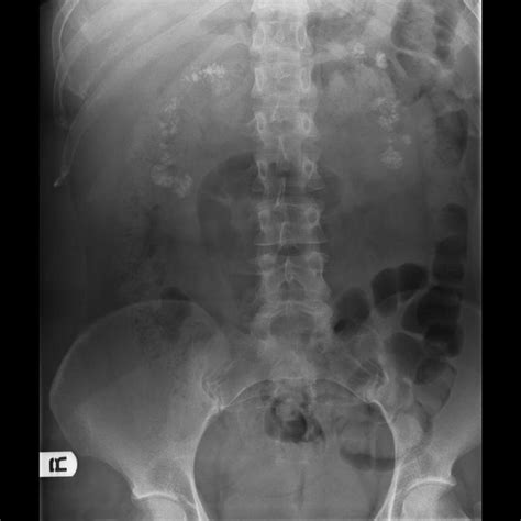 Medullary sponge kidney | Radiology Case | Radiopaedia.org | Medullary sponge kidney, Kidney, Sponge