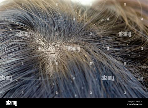 Head lice eggs hi-res stock photography and images - Alamy