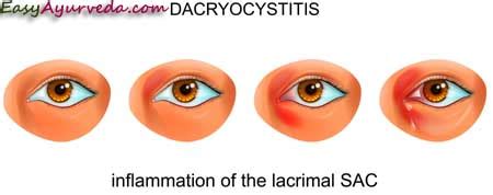 Dacryocystitis Causes, Symptoms, Treatment, Ayurveda Home Remedies