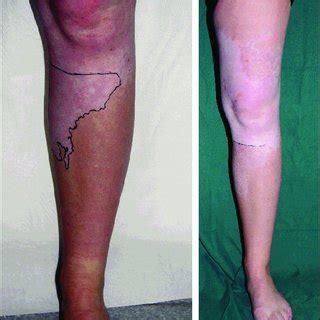 Piebaldism; (a) Before and (b) After treatment with non-cultured... | Download Scientific Diagram