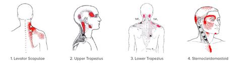 Neck Pain, Headaches & Migraines | Causes & Treatment | Dr. Chris Homan