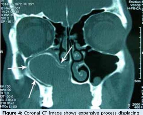 Figure 3 from Clinical and radiological features of a large radicular cyst involving the entire ...