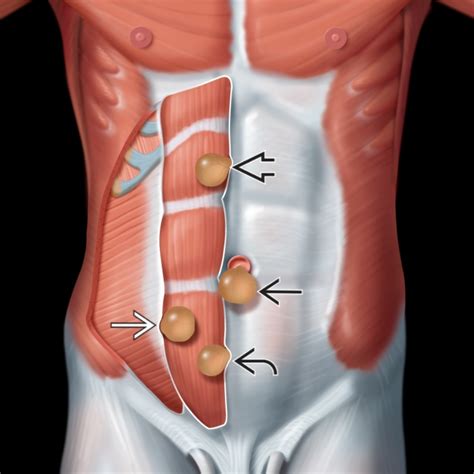 Abdominal Wall Hernia | Radiology Key