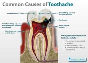 The Tooth Decay Process: Just How To Reverse It And Prevent A Cavity Nationwide Institute Of ...