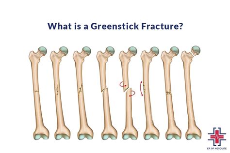 Greenstick Fracture: Causes, Symptoms, and Treatment | ER of Mesquite