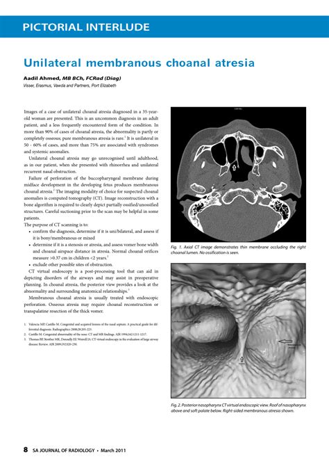 (PDF) Unilateral membranous choanal atresia