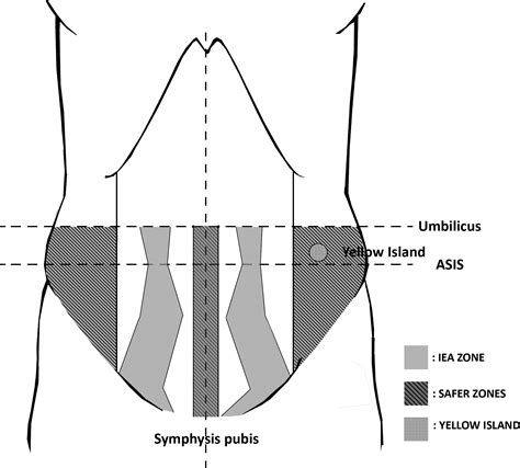 Vigilancia llamada Humilde epigastric artery anatomy asistente Talla maximizar