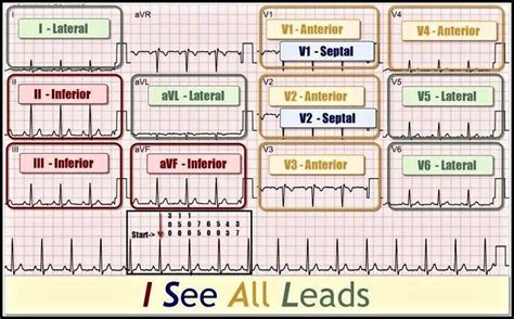 STEMI 12-leads | Nursing mnemonics, Emergency nursing, Nurse