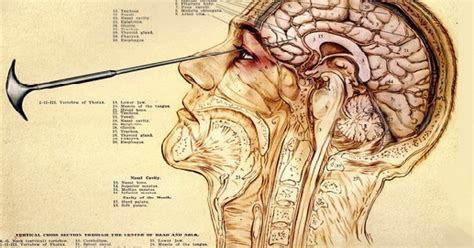 Historia de la lobotomía y sus implicaciones en la psicología