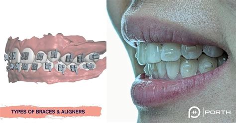 The Ultimate Guide of 12 Different Types of Braces and Clear Aligners