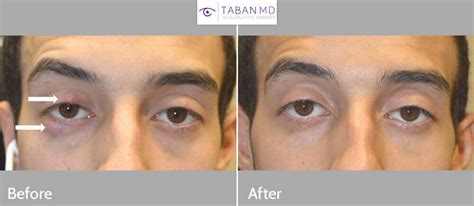 Eyelid Chalazion Surgery Before and After Gallery | Taban MD