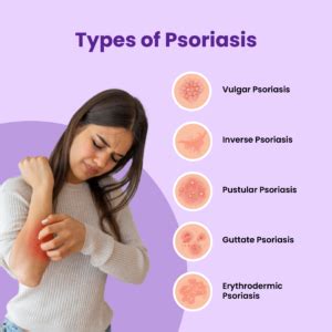 What Is Psoriasis: Symptoms, Diagnosis, Causes & Treatment - MFine