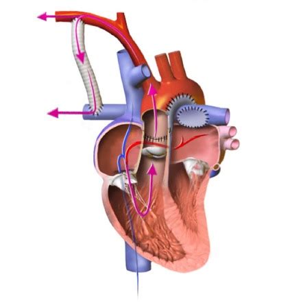 Norwood procedure | Radiology Reference Article | Radiopaedia.org