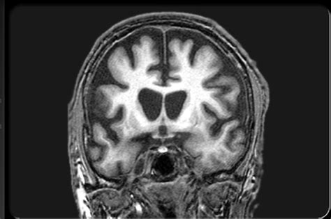 Nutritional Supplement Creatine, Slows Huntington’s disease